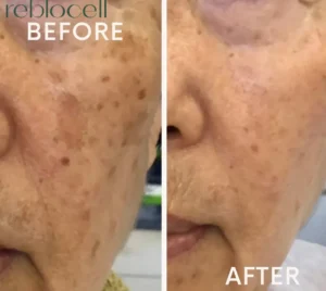 Aging Spots and Melasma Treatment with Laser w/ MTS & EGF-Ampoule & Mask