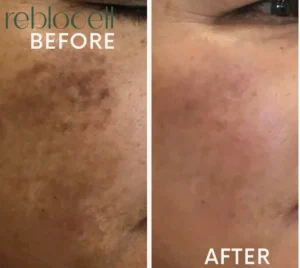 Melasma Treatment with Laser w/ MTS & EGF-Ampoule & Mask