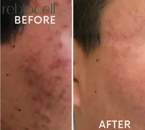 Acne Scars Treatment with Laser w/ MTS & EGF-Ampoule & Mask