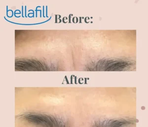 Frown Lines Treatment with Bellafill & Botulinum Toxin