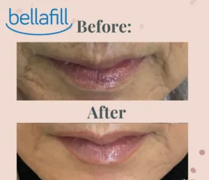 Marionette Lines Treatment with Bellafill
