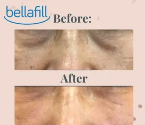 Under Eyes (Tear Trough) Treatment with Bellafill