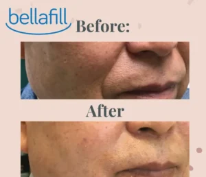 Smile Lines (Nasolabial Folds) Treatment with Bellafill