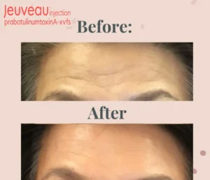 Frown Lines on Forehead Treatment with Jeuveau