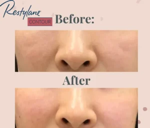 Indian Lines (Hollow Cheek Volume) Treatment with Restylane Contour