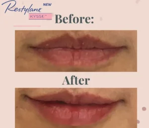 Lip Volume Augmentation with Restylane Kysse